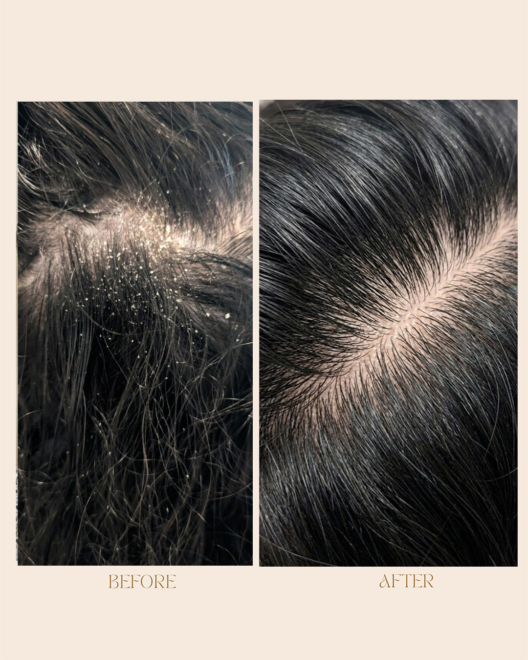 ANTI DANDRUFF SCALP DETOX GEL